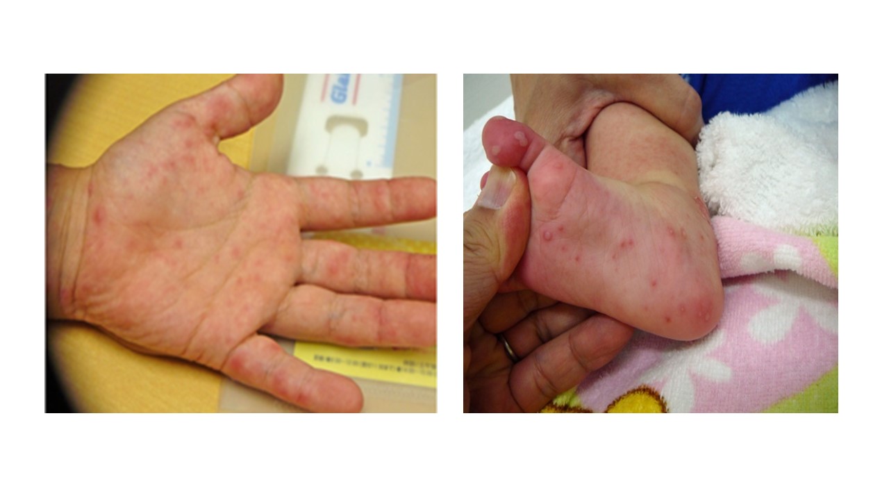 手足口病による発疹（小児）（左；手掌、右；足裏）　　　（写真提供；八尾市八木小児科）